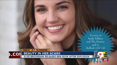 Kilee Brookbank: Girl badly burned in Georgetown explosion continues to give back