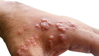 MONKEYPOX OMS