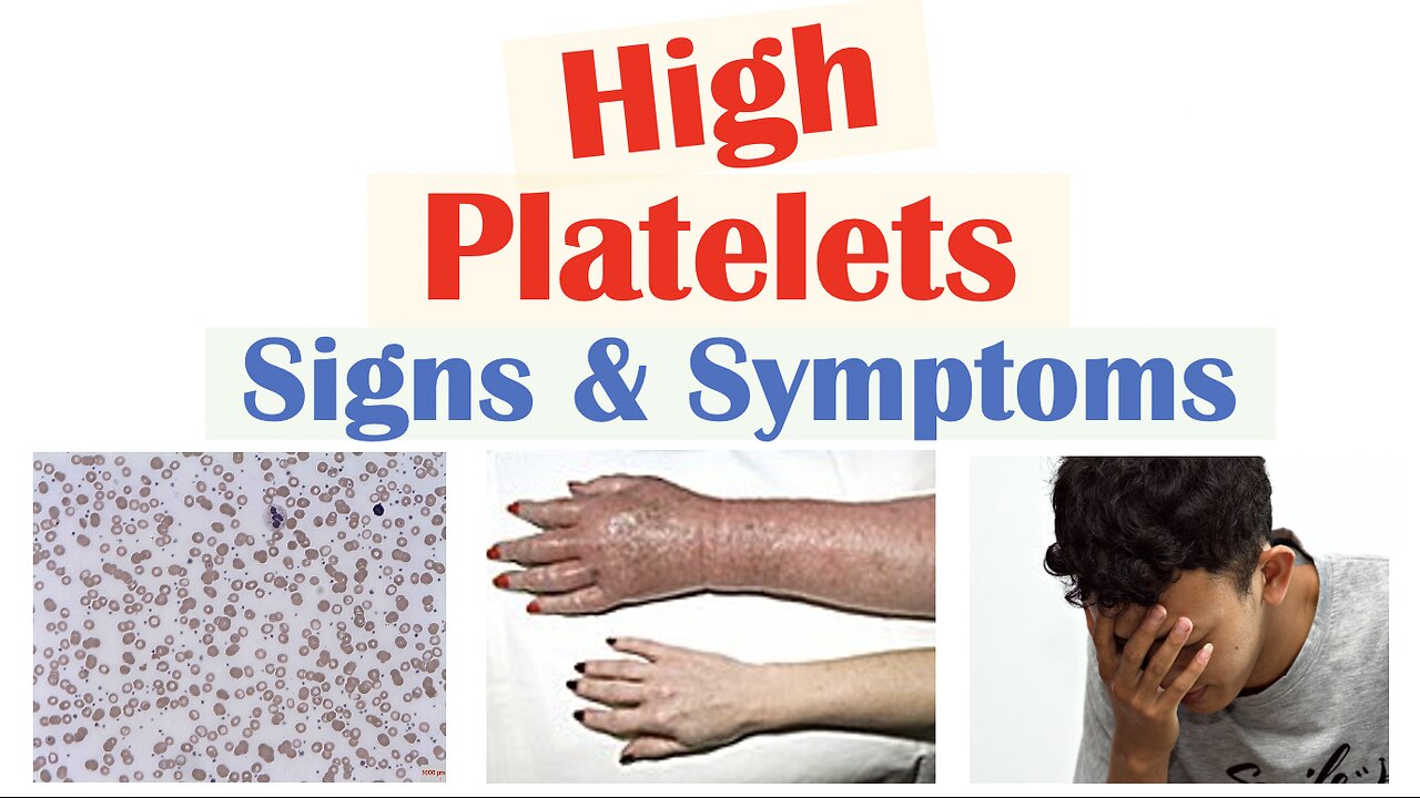 High Platelets (Thrombocytosis) Signs & Symptoms | Rapid Review