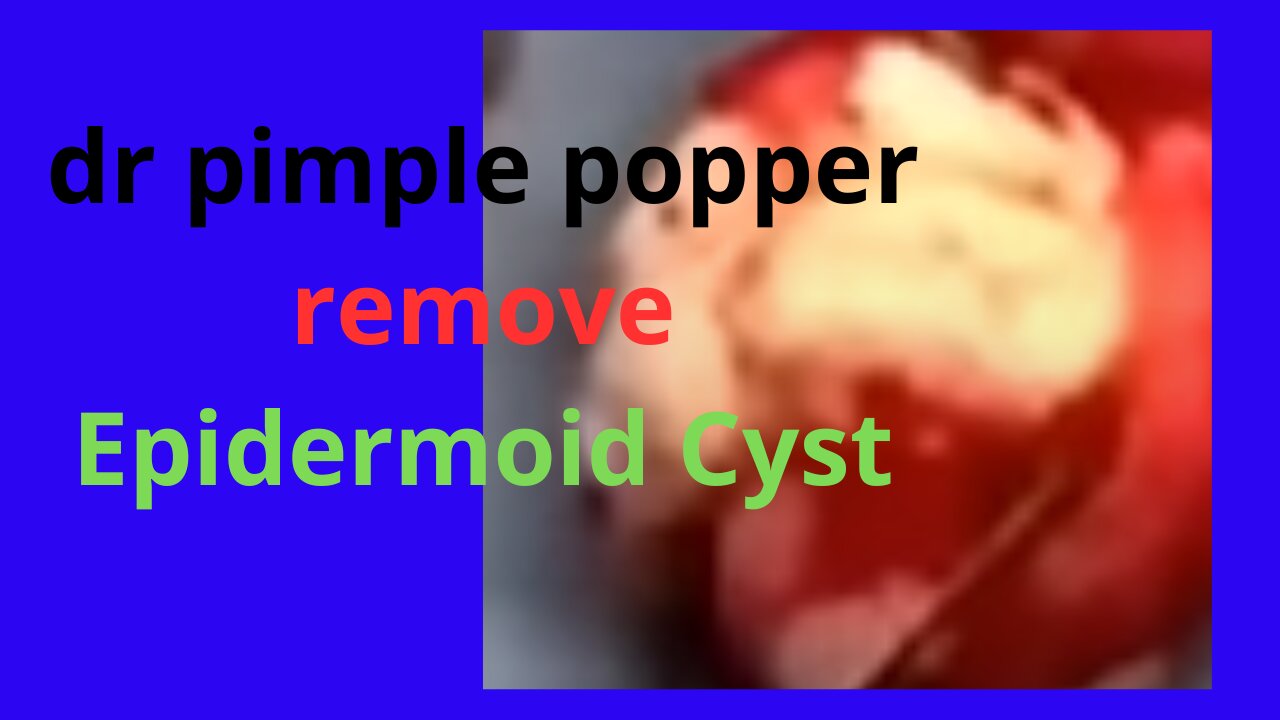 dr pimple popper remove Epidermoid Cyst #dr #pimple #popper #remove