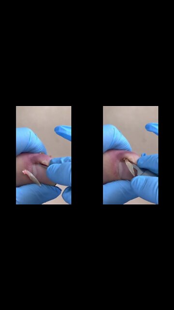 INGROWN TOENAIL EXTRACTION