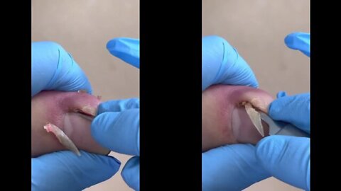 INGROWN TOENAIL EXTRACTION