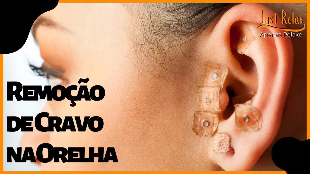 Remoção de Cravo na Orelha - Remove Cravos e Espinhas Asmr - Just Relax | Apenas Relaxe