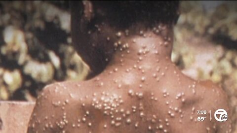Health officials track the spread of Monkeypox