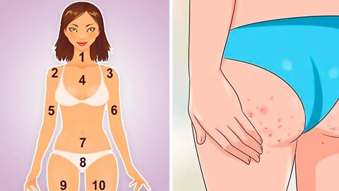 What The Location Of Acne Can Tell You About Your Health