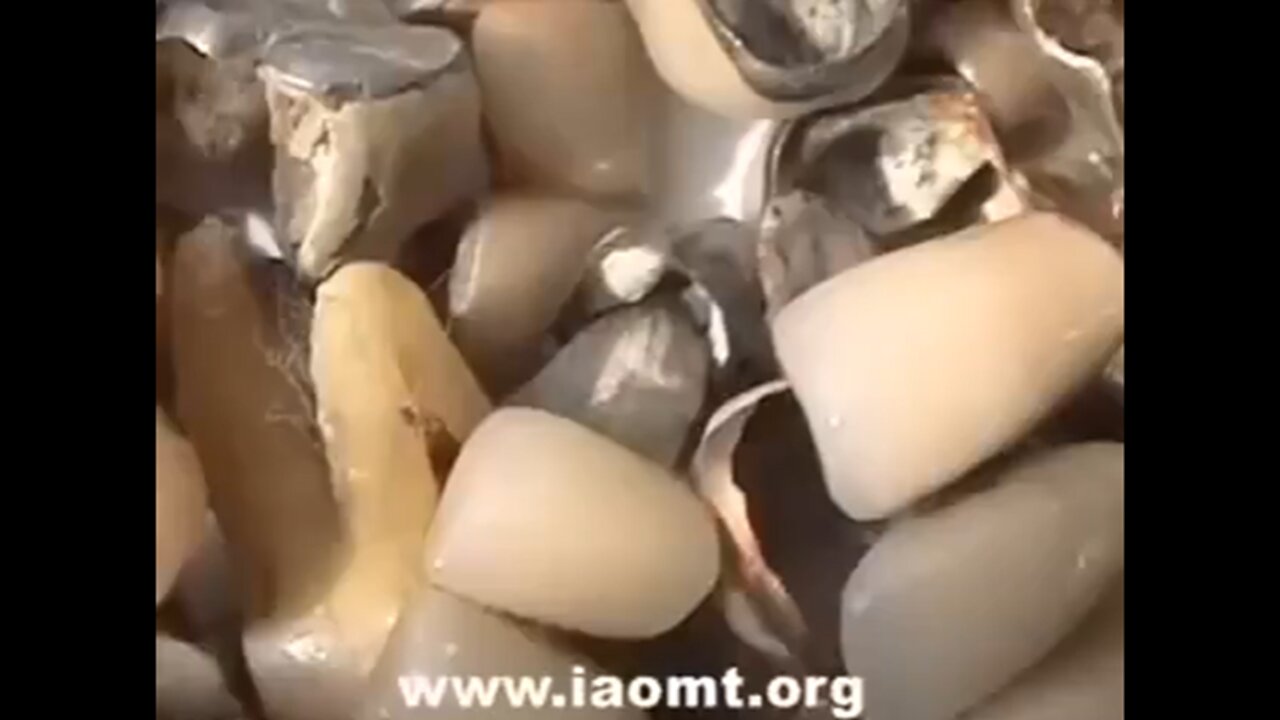 IF YOU HAVE MERCURY FILLINGS IN YOUR MOUTH THEN YOU NEED TO WATCH THIS...