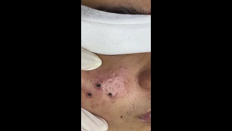 blackhead