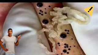 SATISFATÓRIO EXTREMO VÍDEO INCRÍVEL ESPREMENDO CRAVOS E ESPINHAS Black heads Pimple