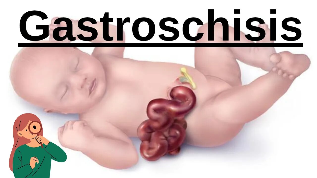 Gastroschisis: Causes, Diagnosis, and Treatment | Novice Medic