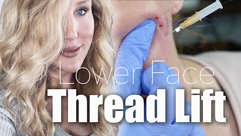 Lower Face Thread Lift | Gorgeously Aging