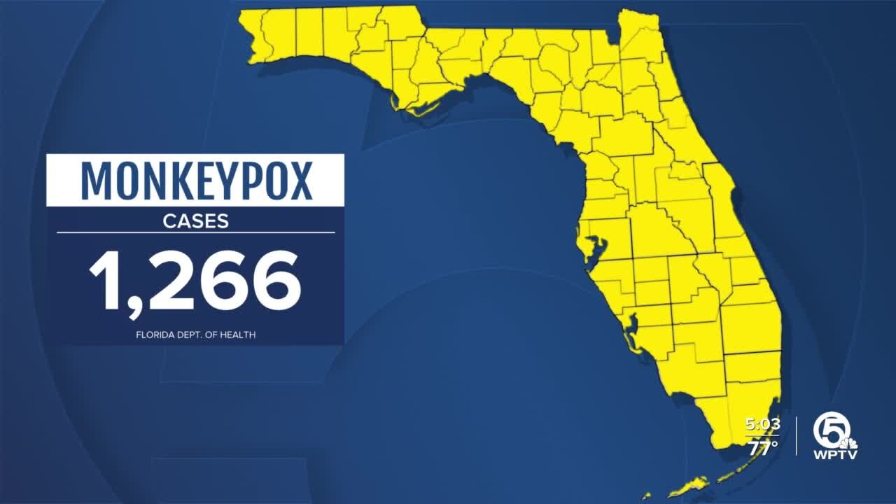 Martin County reports Florida's first monkeypox case in child under 4