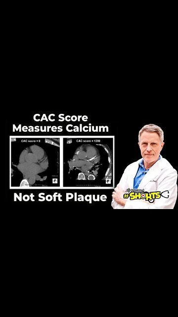 #SHORTS CAC Score Measures Calcium not Soft Plaque, but it is Still useful