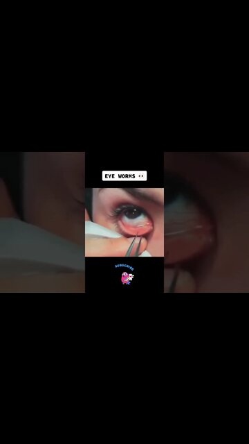 Eye worms Removal - wtf? #eyeworm #blackheadsremoval #pimple