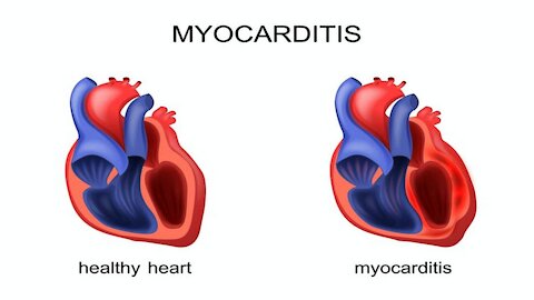 Heartbeat - myocarditis amongst the children.