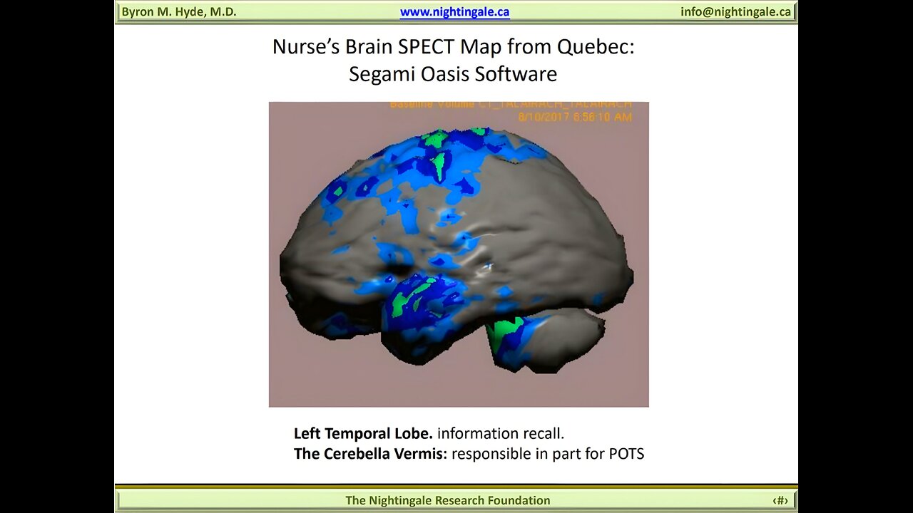 Nurse's Brain SPECT Scan taken with a Lumbar Puncture case - Byron Hyde, MD