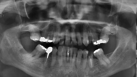 Nutrition 12 Dental Caries