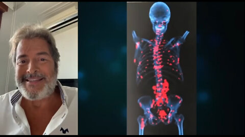 CÁNCER DE PRÓSTATA EN ESTADO TERMINAL TIENE CURA