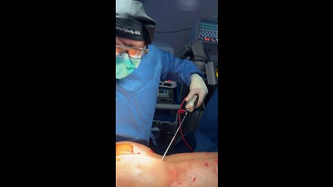 Thigh lift BBL surgery - BBL surgery experience