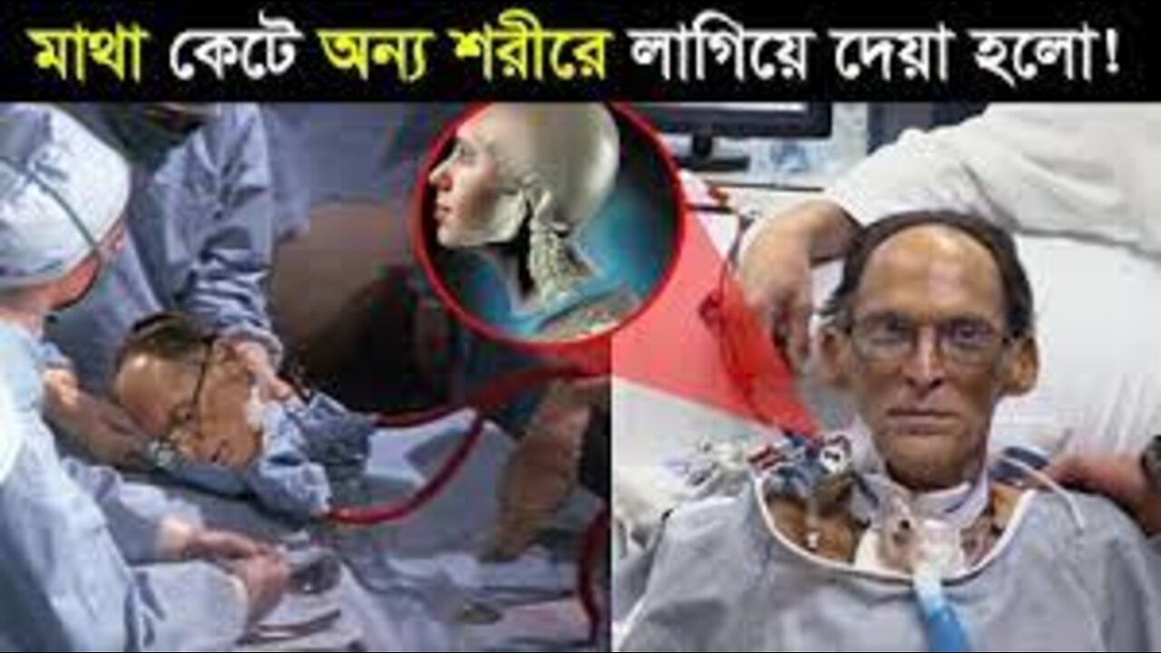 মাথা প্রতিস্থাপন | এক শরীর থেকে মাথা কেনে অন্য শরীরের লাগানো হলো | Head transplant