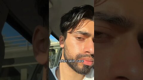 3 Year Skin Transformation