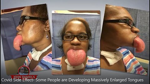 Covid Side Effect- Some People are Developing Massively Enlarged Tongues