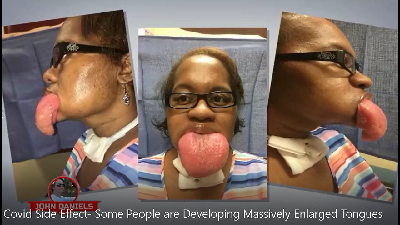 Covid Side Effect- Some People are Developing Massively Enlarged Tongues