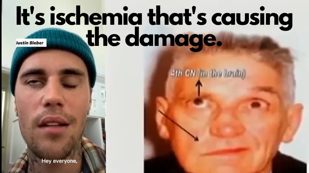 It's impaired blood flow caused by the "vaccine".