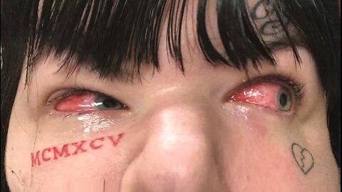 Prostitute Gets Chlamydia In Her Eye