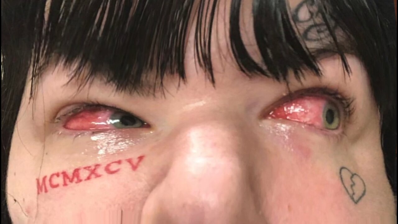 Prostitute Gets Chlamydia In Her Eye