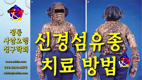신경섬유종 (유전질환) 치료 방법 - 비과학적 양의학 172 - 사암침, 사암침법