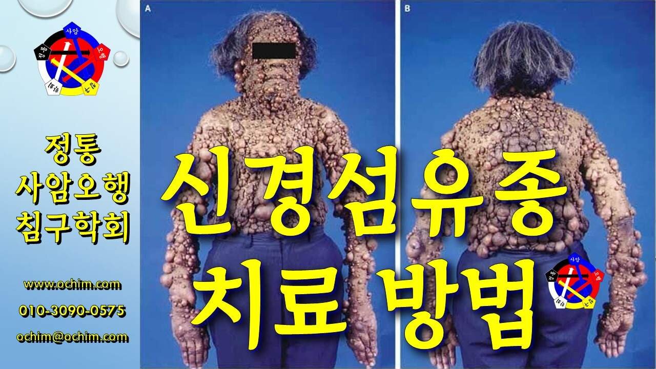 신경섬유종 (유전질환) 치료 방법 - 비과학적 양의학 172 - 사암침, 사암침법