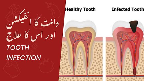 Tooth infection