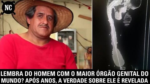 Lembra do homem com o maior órgão do mundo? Após anos, a verdade sobre ele é revelada