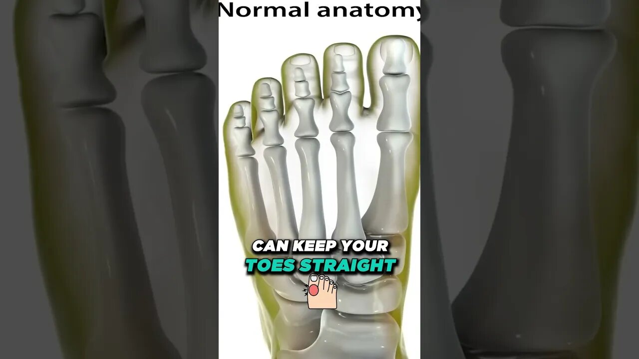 What is a Bunion? [What causes bunions & How to get rid of bunions!]
