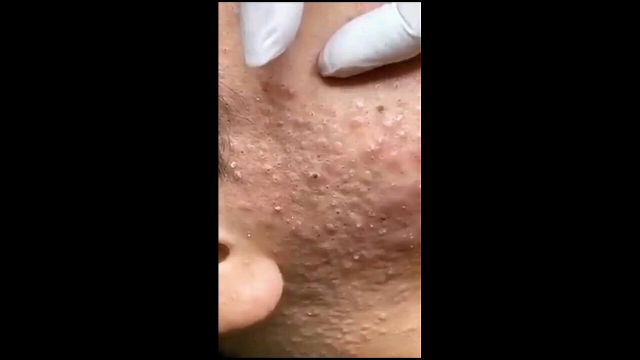 Blackheads episode 49