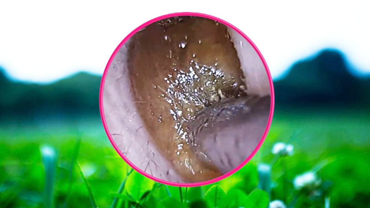 Ear Wax Removal With Clam Relaxing Music #38