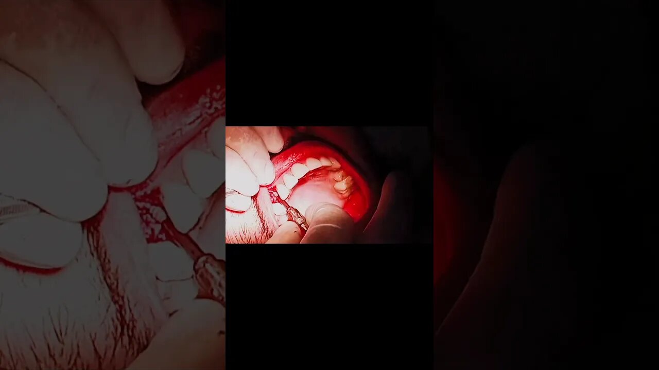 Implant surgery|Mk Dentist