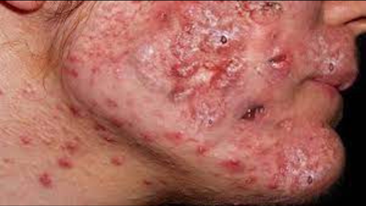 Acne Blackheads on back ll acne blackheads on lips