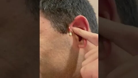 Cyst Ear Burst! Abscess/Boil | Oddly Satisfying Videos