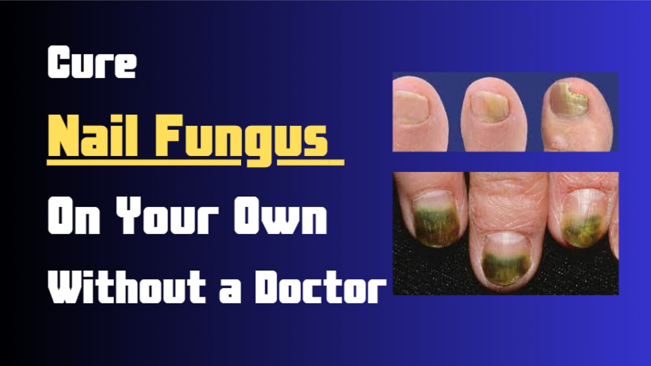 5 Ways To Cure Nail Fungus At Home