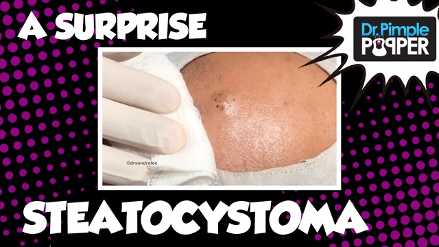 A Surprise Steatocystoma!