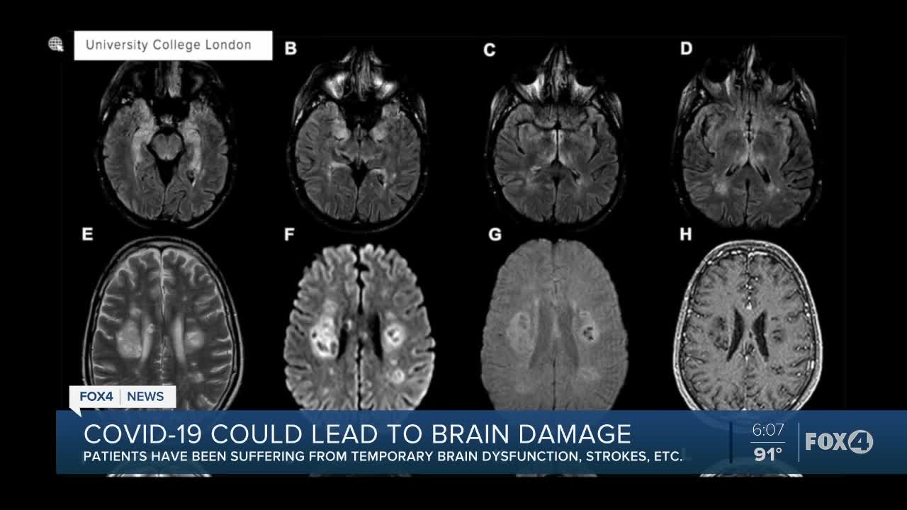 Scientists say coronavirus could lead to brain damage