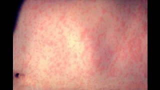 Denver adult tested positive for measles, visited multiple locations around city while contagious