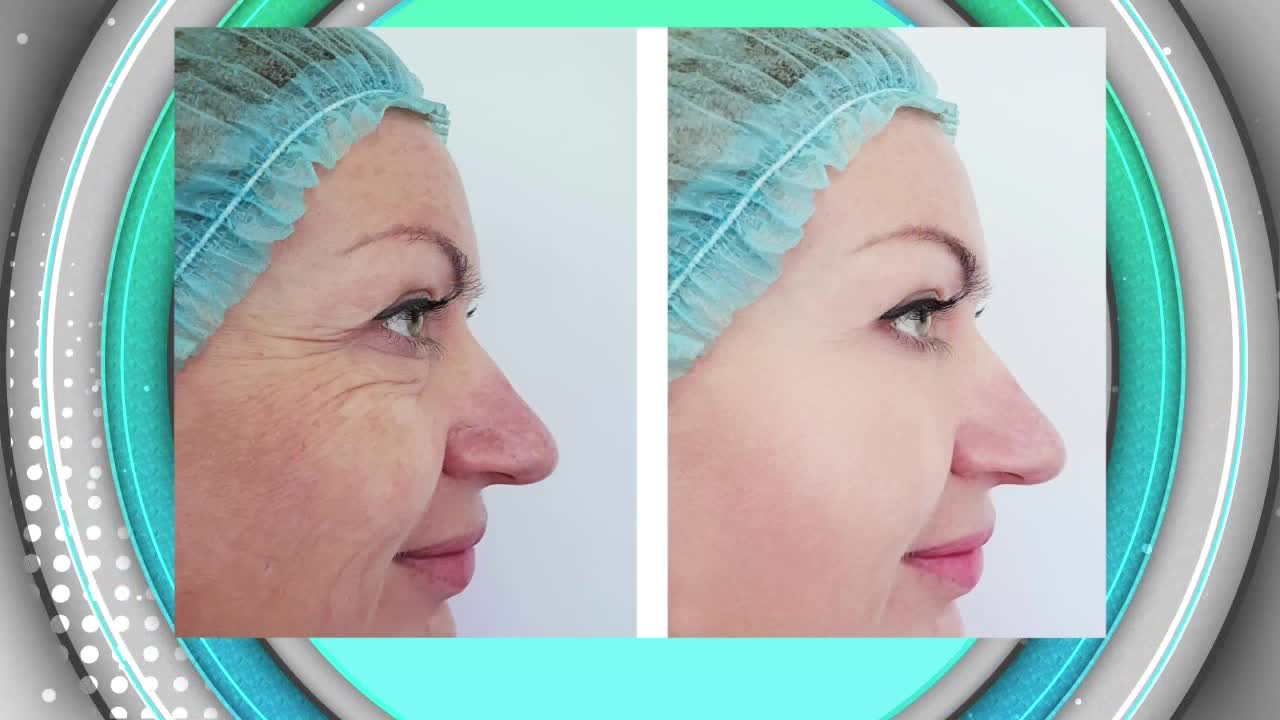 Hollywood Body Laser-Removing Fat and Non Surgical Facelifts