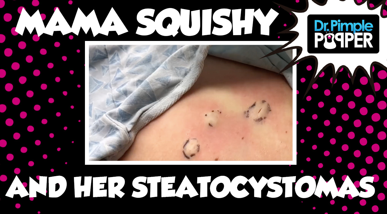 Momma Squishy & Her Happy Steatocystomas!