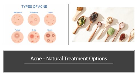 Acne Natural Treatment with Herbs & Supplements