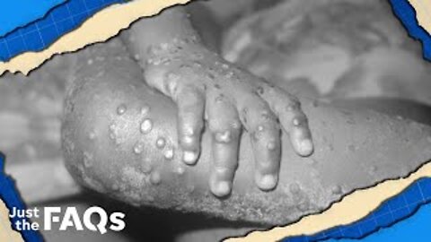 Here's why we shouldn't be too concerned about monkeypox | JUST THE FAQS