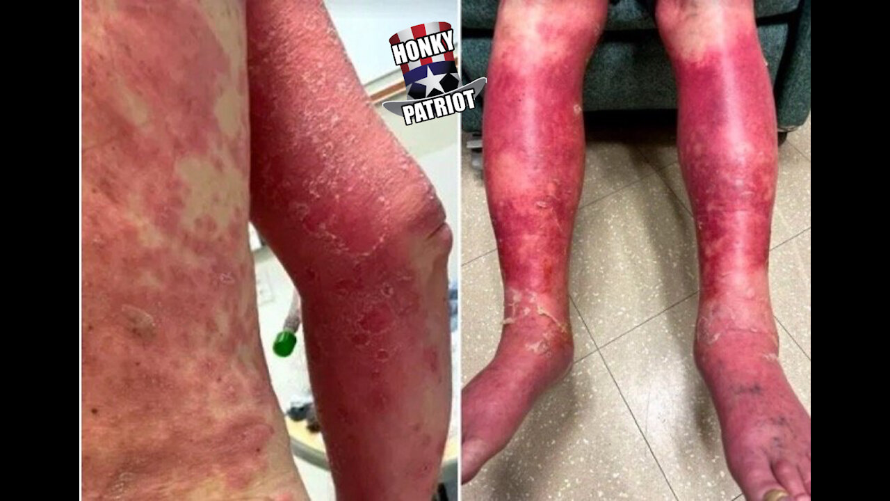 SEVERE COVID-19 VACCINATION SIDE EFFECTS !