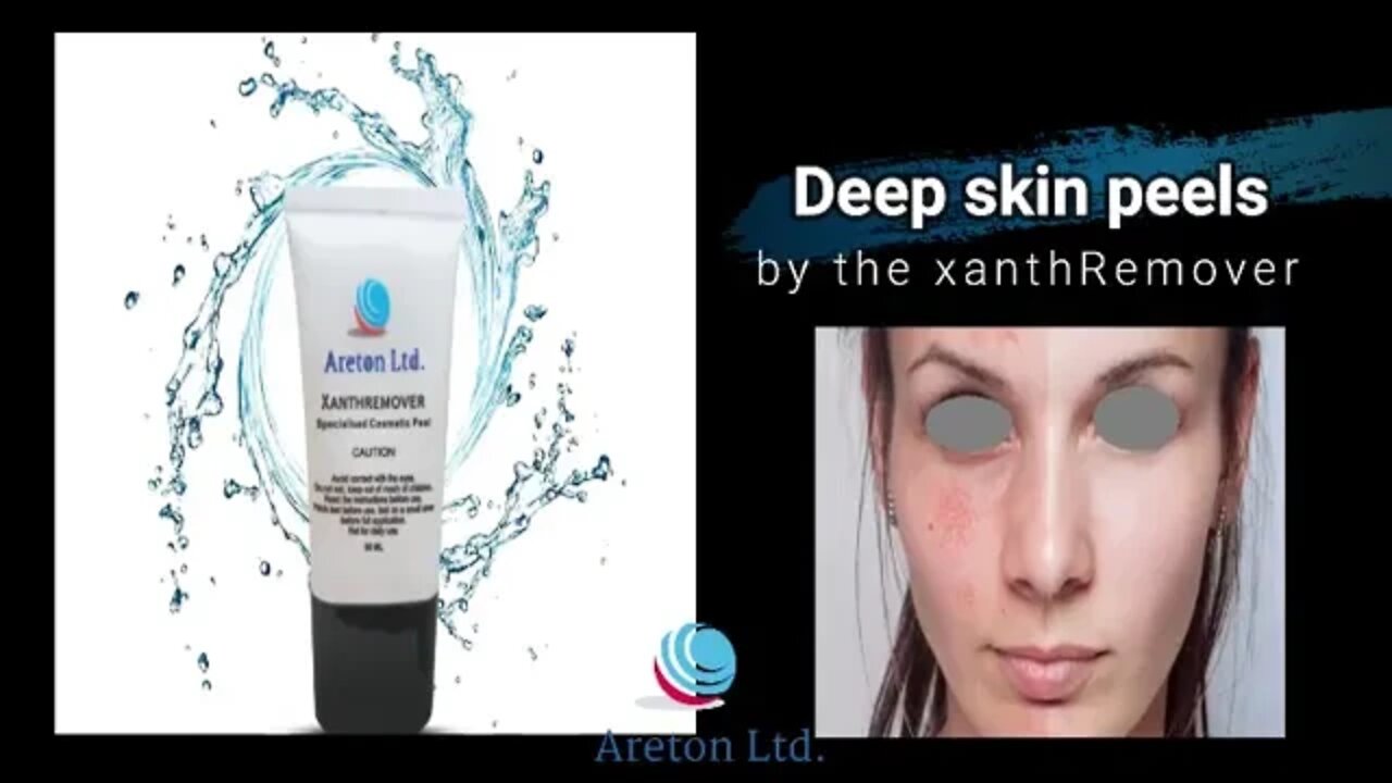 Get Rid of Seborrheic Keratosis, Age Spots, Xanthelasm.. with Xanthremover Glycolic acid Peel