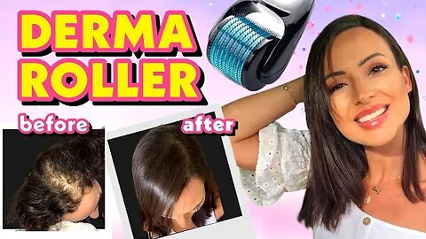 DIY TREATMENT DERMA ROLLER FOR HAIR LOSS + MIRACLE SECRET CURE!